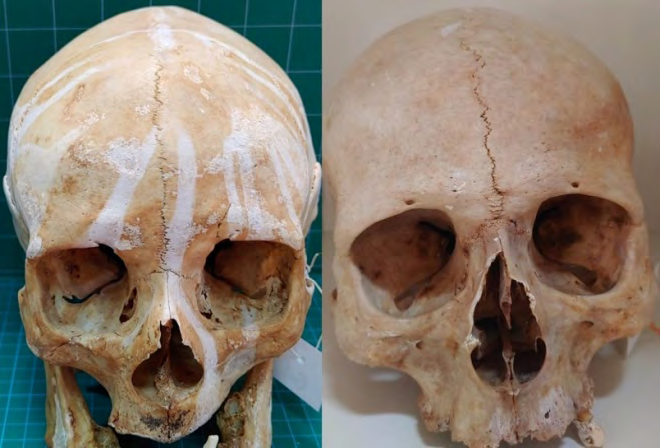 Figure 1: Metopism (left side) and combined-supranasal Metopism (right side).