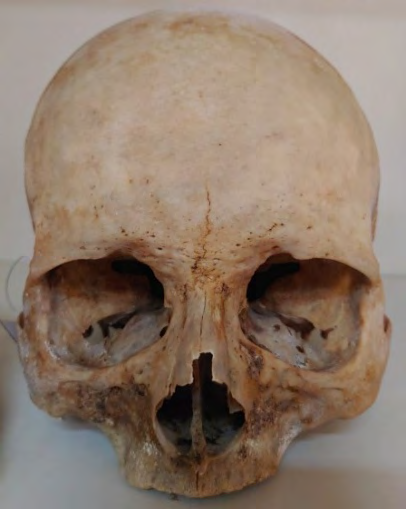 Figure 2: Remnant of a Median Suture.