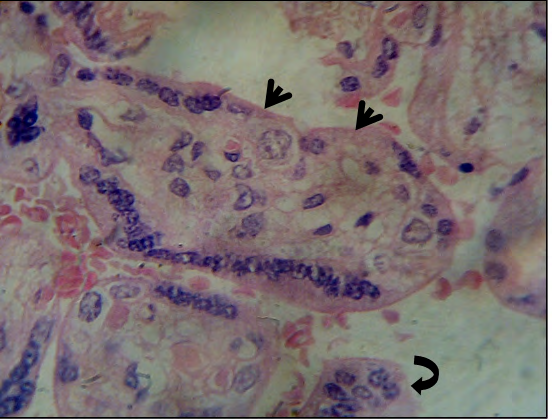 Figure 4: Villi which has detached syncytial region [arrows] similarly to the indicated by the curba arrow.H&E.1000x.