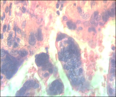 Figure 7: Groups of nucleus sticking out of the villi.H&E.1000x.