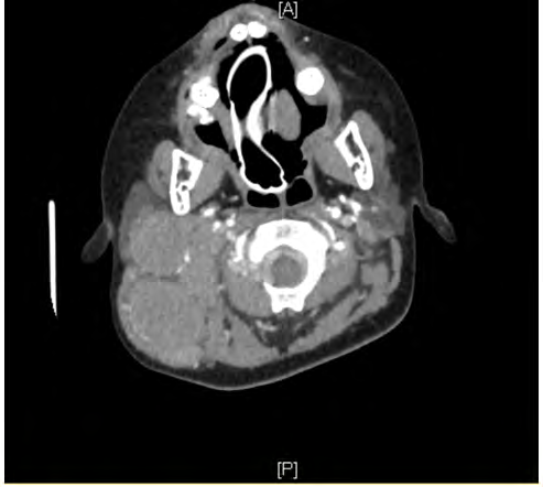 Figure 1: CT scan – Axial cut demonstrating multiple well- defined masses of different sizes in the right deep cervical chain.