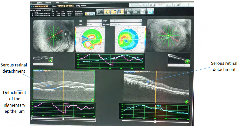 Figure 3: Radial macular OCT image of the patient’s left eye on readmission showing a serous central retinal detachment, a serous detachment of the pigmentary epithelium.