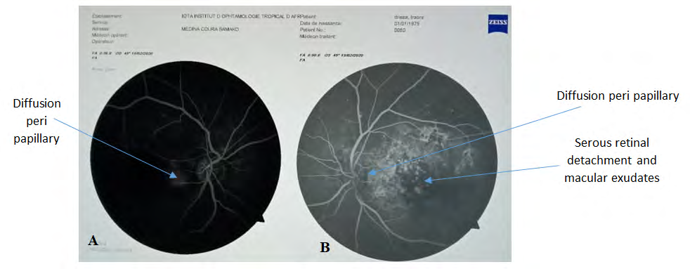 Figure 4: Fluorescein angiography image at the arterial time of the patient’s readmission. A: In the right eye, diffusion was observed at the level of the peri-papillary neo-vessels. B: In the left eye, there was diffusion of the peri-papillary neo-vessels, macular exudates and localized mass effects in the macula.