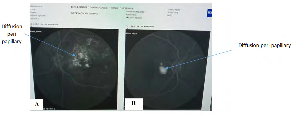 Figure 5: Fluorescein angiography image at the venous time of the patient’s readmission. A: A In the left eye, the accentuation of the diffusion of the peri-papillary neo-vessels and macular exudates was noted. B: A In the right eye, the diffusion of the peri-papillary neo-vessels was also accentuated.