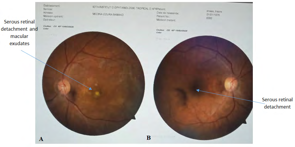 Figure 6: Photograph of the patient’s retinography at readmission. A: A In the left eye there were peri-papillary neo-vessels, macular exudates, retinal serous detachment and macular scars. B: A the right eye was mainly peri-papillary neo-vessels.