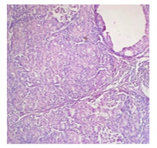 Figure 2: Specimen of breast tumor cut surface showing grey-white, firm solid, irregular.