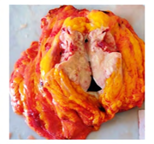 Figure 3: FNAC smears positive for carcinoma cells.