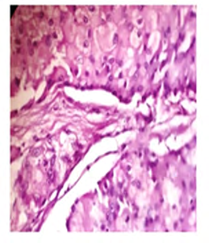 Figure 4: Photomicrograph showing apocrine carcinoma of breast (H & E stain, 40x).