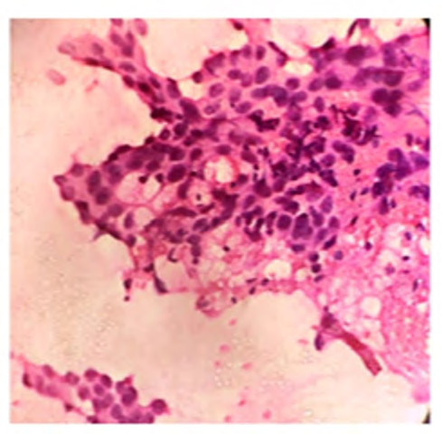Figure 5: Showing apocrine carcinoma of breast Type A-Tumor cells with abundant acidophilic cytoplasm with eosinophilic granules, central to eccentric vesicular nuclei with prominent nucleoli – (Hand E stain, 100x).