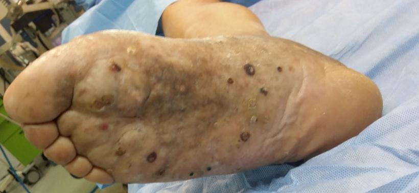 Figure 1: Plantar Aspect of the Right Foot Showing Fistulas with Nodular Plaques.