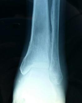Figure 4: Periosteal Reaction of Distal Tibia and Fibula