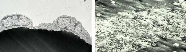 Figure 1: ** Electron Photomicrographs of Endothelial Cells and Activated Platelets. (Courtesy: Dr (Late) James G White, University of Minnesota) In a recent article, Guo and associates from China conclude, “Our data support the notion that diabetes should be considered as a risk factor for a rapid progression and bad prognosis of COVID-19” [45]. In this point of view article, we propose that for people with underlying conditions such as hypertension, excess weight, obesity, type-2 diabetes and vascular diseases, coronavirus infection poses an added risk and if intensive attentions are not paid, severity of coronavirus may cause irreversible damage to the tissues, vital organs, and result in organ failure and death.