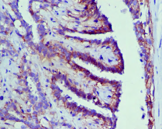 Figure 6: Intraductal papilloma-P Cadherin Positive (TS 8).