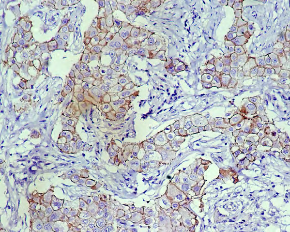 Figure 9: IDC-P Cadherin Positive (TS 4).