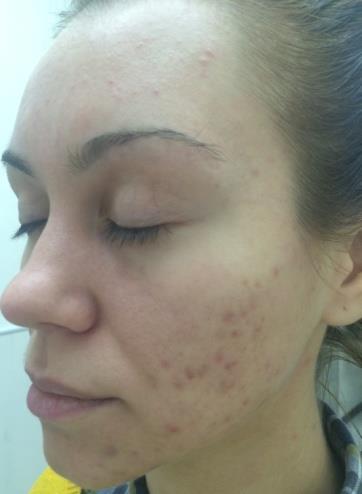 Figure 1: Patient Z., 28 years, group II. Figure 2: Patient A., 32 years, group II. Diagnose: Rosacea, erythematotelangiectatic subtype. Diagnose: Rosacea, papulopustules subtype.