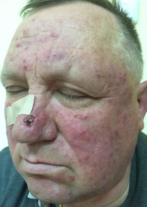 Figure 5: Patient V., 61 years, group I. Figure 6: Patient V., 67 years, group I. Diagnose: Rosacea, papulopustules subtype. Diagnose: Rosacea, papulopustules subtype. Demodicosis. Mite load was 12 mites per 1 cm² in scraping. Demodicosis. Mite load was 7 mites per 1 cm² in scraping.