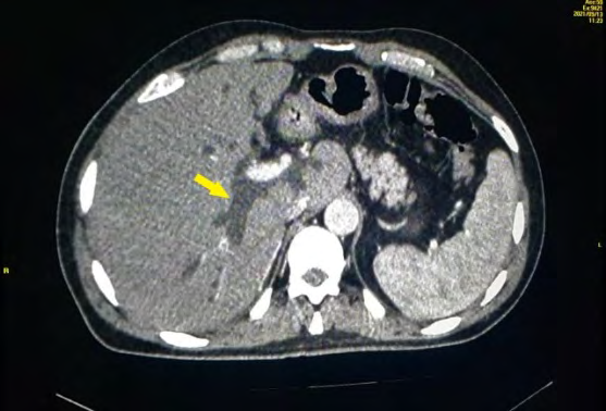 Figure 1: Dilation of the intrahepatic bile ducts upstream of the tumor process of the hilar plate.
