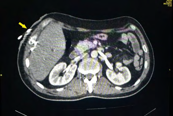 Figure 2: External bile drain.
