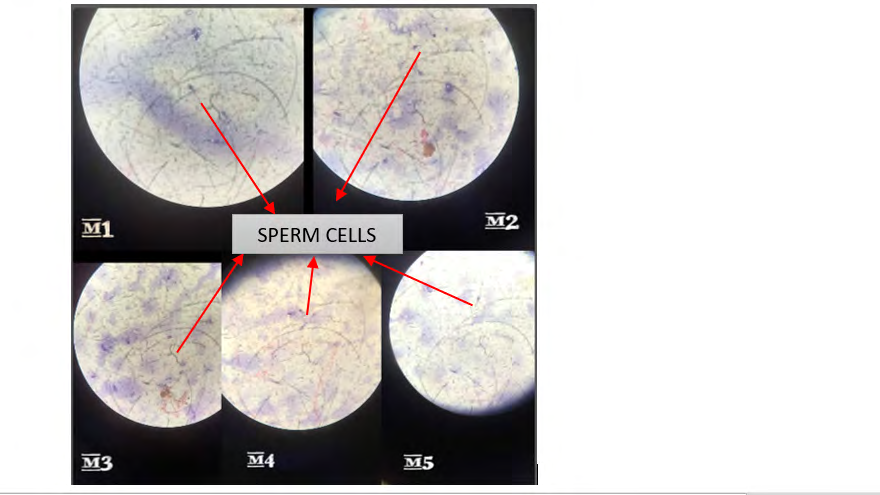Figure 1: Sperm cells in seminal stain of M1, M2, M3, M4 and M5 respectively.