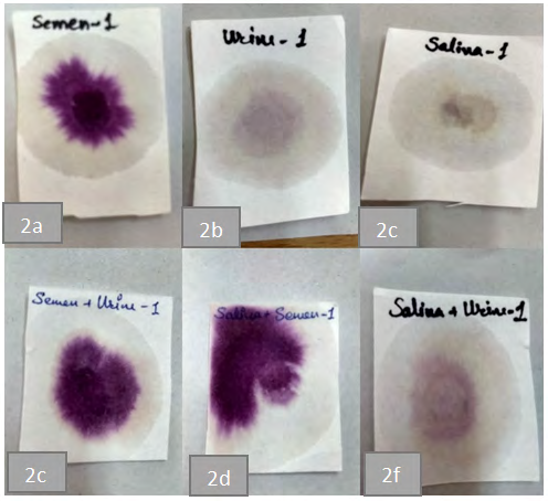 Figure 2: Acid phosphatase activity in semen, urine, saliva, semen mixed with urine, semen mixed with saliva and saliva mixed with urine samples of M1.