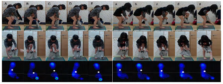 Figure 10: Photographic playback during trouser-wearing motion before and after OT intervention (participant L). The left side indicates the foot of first leg ( from takeoff to landing before OT intervention, and the right side indicates it after OT intervention Top indicates photos from the sagittal plane, middle indicates photos from the frontal plane The bottom indicates the foot pressure distribution and the center of pressure ( of the first support leg ( Dark blue indicates weak pressure, green indicates strong pressure White circles indicate COP ..” and “ indicate when the FL begins to move ..” and “ indicate when the foot of the FL has risen to the waistline of the trousers ..“ and “ indicate the moment when the foot of the FL was inserted into the waist of the trousers ..” and “ indicate the moment when the FL’s foot passes through the hem of the trousers ..“ and “ indicate the moment when the foot of the FL was set on the floor The photographic playback of the trouser-wearing motion of participant L before and after the OT intervention is shown in Figure 10. Comparing “A” and “a” before and after the OT intervention, the characteristics of the motion images were similar. Foot pressure distribution was similar in the COP position, although the pressure at the heel was higher after the intervention. Comparing “B” and “b,” there was greater forward flexion of the trunk after the intervention. Before the intervention, the foot pressure increased in the thumb, and the COP shifted forward. On the other hand, there was less thumb pressure and little COP shift after the intervention compared with before. Comparing “C” and “c,” trunk forward flexion was greater after the OT intervention. Before the intervention, the foot pressure increased at the heel, in addition to that of the thumb, and the COP moved backward. After the intervention, the thumb pressure decreased, and the COP moved slightly forward. In the comparison between “D” and “d,” before the intervention, the trunk was becoming vertically extended, whereas there was no change after the intervention. Before the intervention, the position of the trousers was fixed, and the FL passed through the hem. The foot pressure at this point increased on the fifth midfoot side, and the COP moved forward again. After the OT intervention, the participant pulled up the trousers with both upper limbs while passing the FL through the trousers. In this case, the foot pressure increased on the 5th metatarsal side, and the COP moved forward similarly before the intervention. In the comparison between “E” and “e,” the FL foot did not pass through the trousers before the intervention, and the FL foot was on the floor. The foot pressure of the FSL was high at the toe and the heel, and no ground contact was observed on the fifth metatarsal side. However, after the intervention, the FL passed through the trouser leg opening, while the trousers were pulled up to the waist, the foot pressure of the FSL weakened on the 5th metatarsal side, and the COP moved backward.