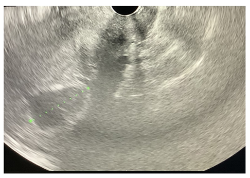 Figure 1: Confirmation of pregnancy by transabdominal ultrasonography.