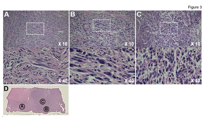 Figure 3: Histopathological studies of a new tumor adjacent to the previously diagnosed tumor.
