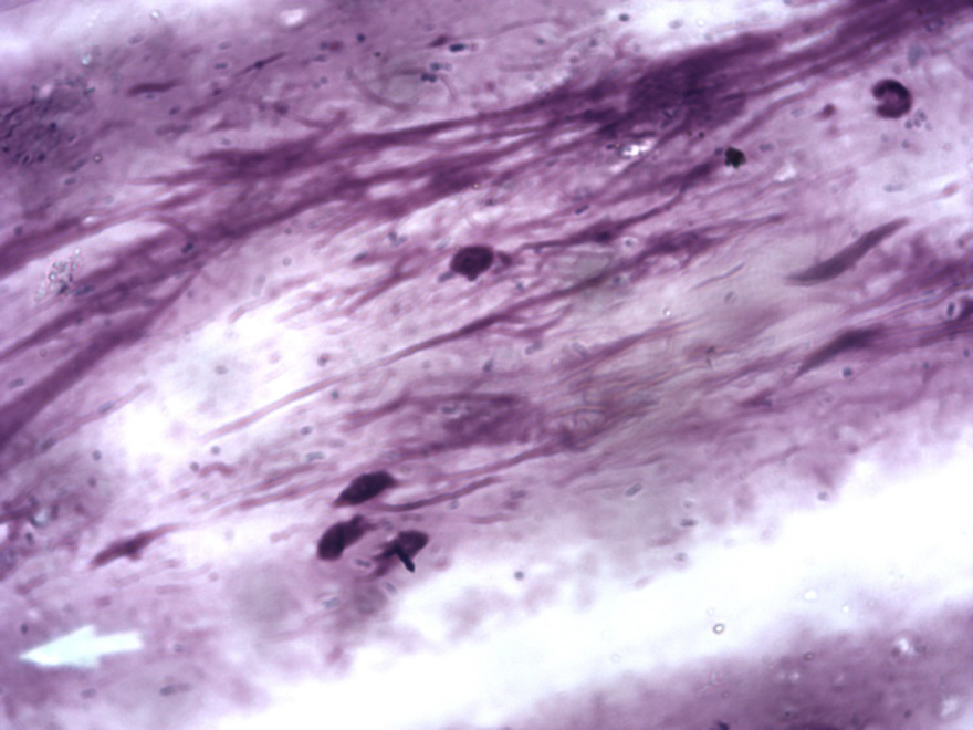 Figure 2: Amastigote forms of leishmanias observed in an infant in Bangui, 2020 (X100)