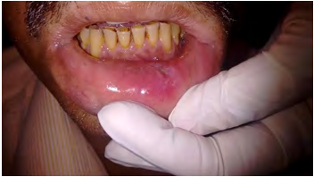 Figure 4: Extraoral photograph showing reduction of lower lip swelling post treatment.