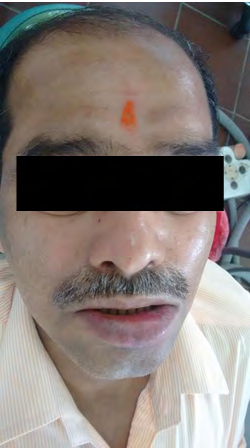 Figure 5: Intraoral image showing healing of lower lip ulcer post treatment.