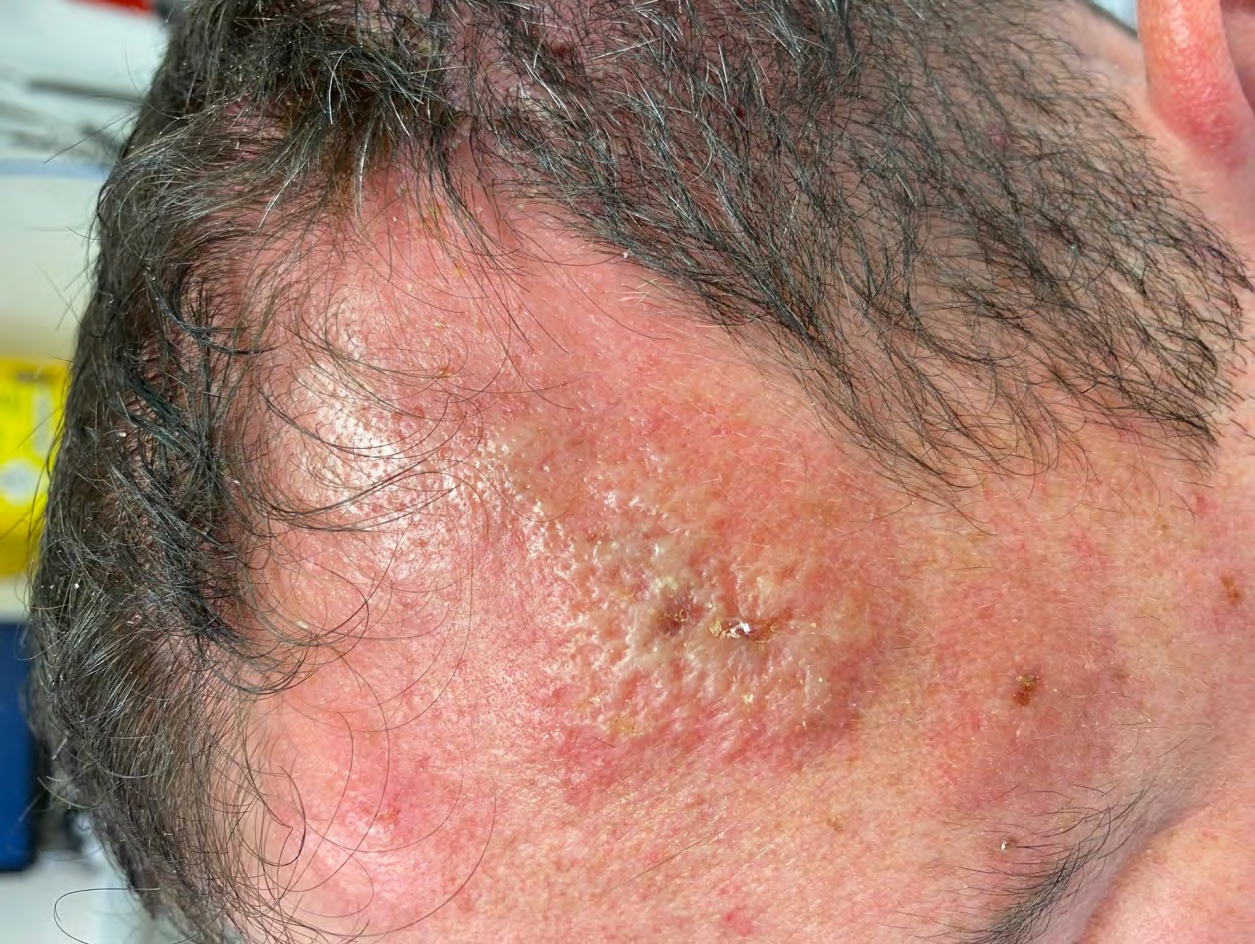 Figure 1: Significant confluent blistering in the left temporal region.