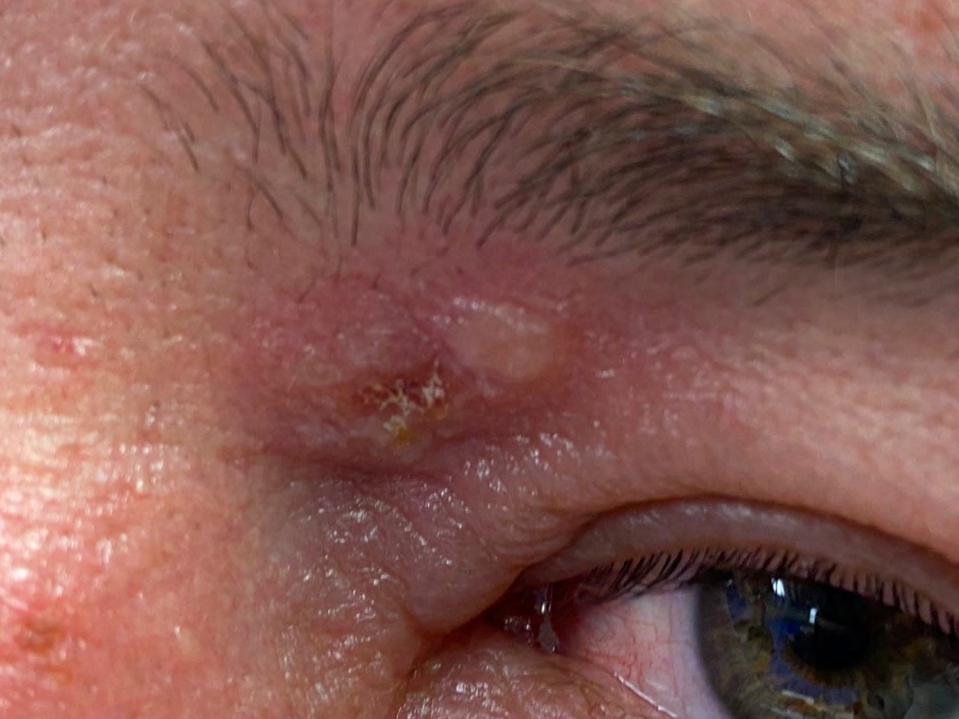 Figure 2: Periorbital vesicle and periorbital oedema.