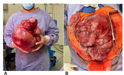 Figure 1: 10,250 kg tumor.