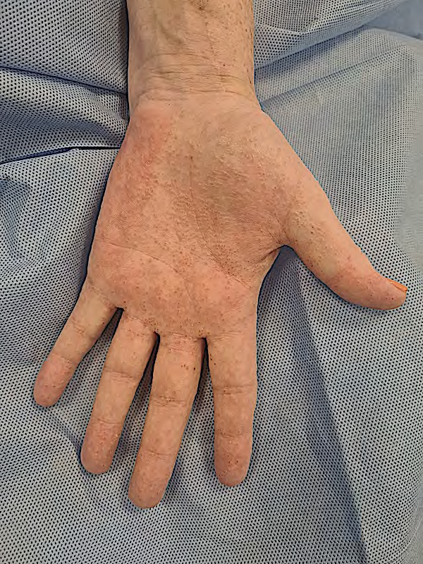 Figure 1: Discrete vesicular eruption on palm of right hand.