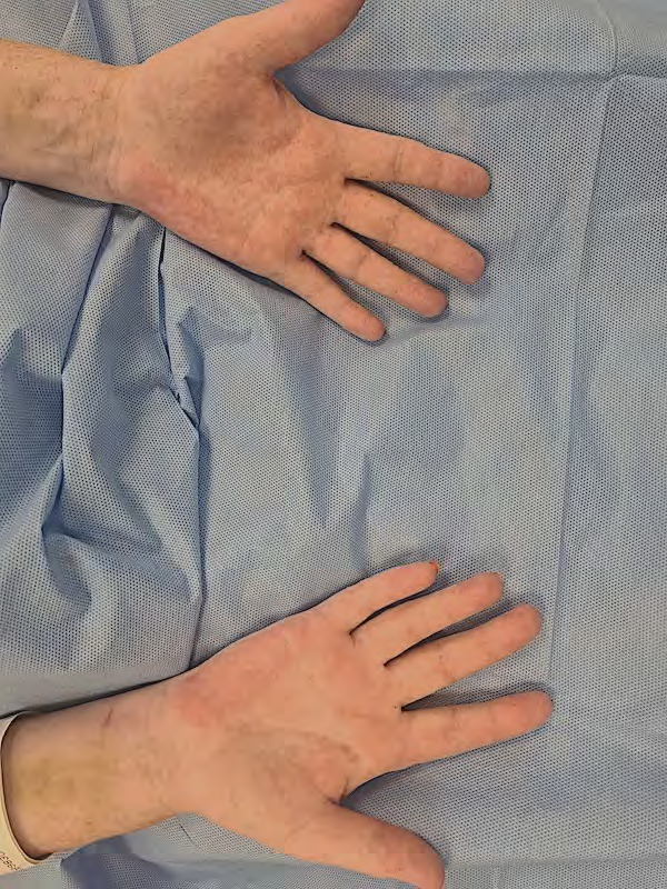 Figure 2: Discrete vesicular eruption on palms of both hands.