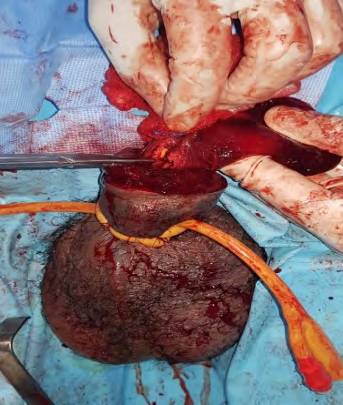 Figure 3: An incomplete urethral rupture with fractures of the corpus cavernosum and corpus spongiosum.