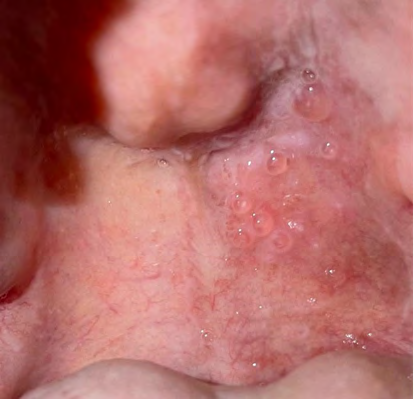 Figure 1: Multiple tense, translucent vesicles of SM of 1-5 mm in diametres located on the left side of the soft palate, presented on the first encounter with the patient. The right side of the soft palate is free of lesions.