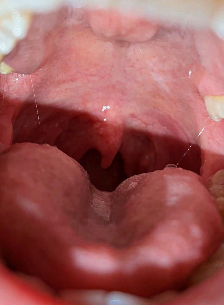 Figure 2: The left side of the soft palate is totally free of SM at the end of 4 months of treatment. The white speck is the scar left by the biopsy wound.