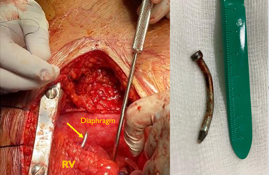 Figure 2: Plain CT chest. Figure A and B: The 3-Dimension transformation views. Figure C and D: Showing the classic CT views denoting the FB highly suspicious to be intra-pericardial. Figure E: The intraoperative epicardial modified ultrasonography showing the FB retained within the inferior diaphragmatic wall of the RV.
