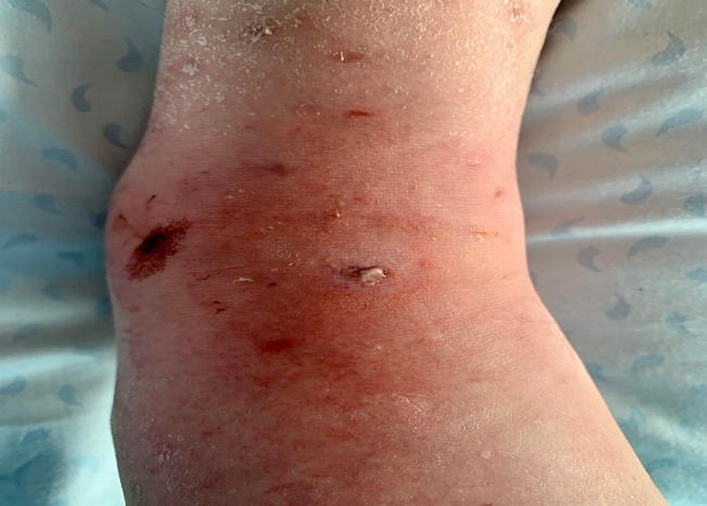 Figure 2: Spontaneous purulent discharge occurring at the center of the erythematous induration.