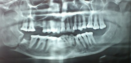 Figure 1: Mandible Fracture.