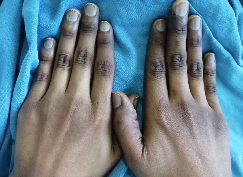 Figure 2: Hyperpigmentation of skin and attachments (nails) is denoted.