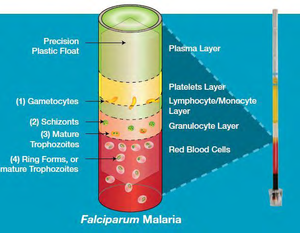 Figure 2: Quantitative Buffy Coat (QBC) Test for Plasmodium falciparum [15].
