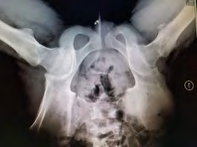 Figure 1: X-ray: narrowing of left hip joint space and mild osteopenia.
