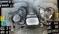 Figure 2: MRI hip: edema seen along the the opposing articular surface of acetabulum, mild joint effusion, with synovial thickening, mild surrounding soft tissue edema, no sizable collection or abscess formation, normal muscles and normal femoral head .
