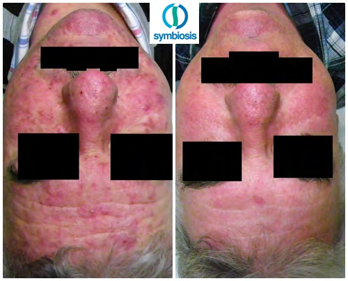 Figure 1: Proband before and after the introduction of in-office treatments and home care (zero test and a test after 6 weeks of treatment).