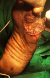 Figure 3: Post skin grafting.