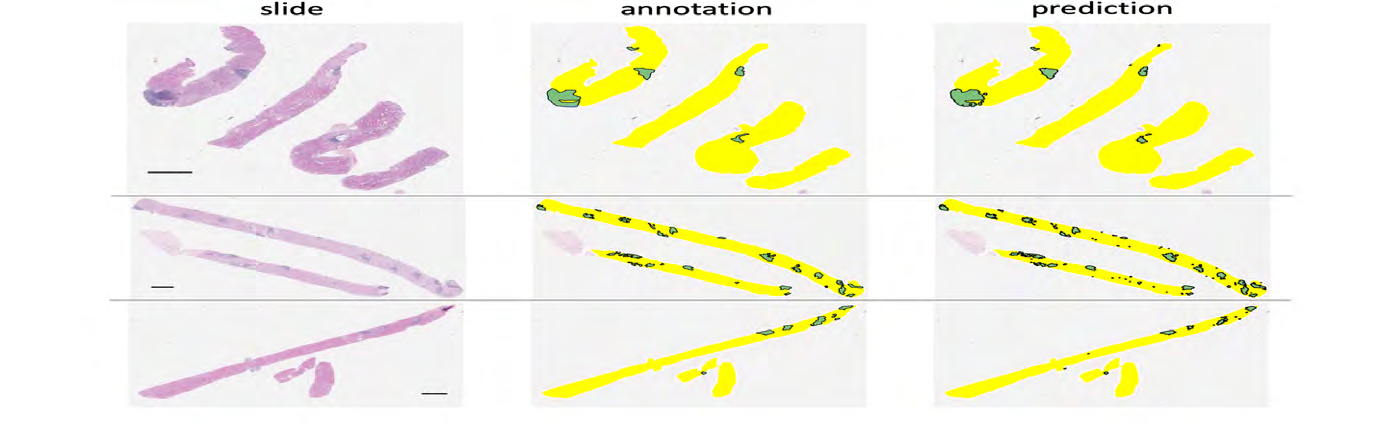 Figure 1: A coarse-level visualization of three representative core needle biopsy slides (left) alongside with LAs annotations provided by a renal pathologist (middle) and neural network prediction (right). Predictions with area less than 15,000 pixels are removed. The black horizontal bar indicates scale of 1mm.