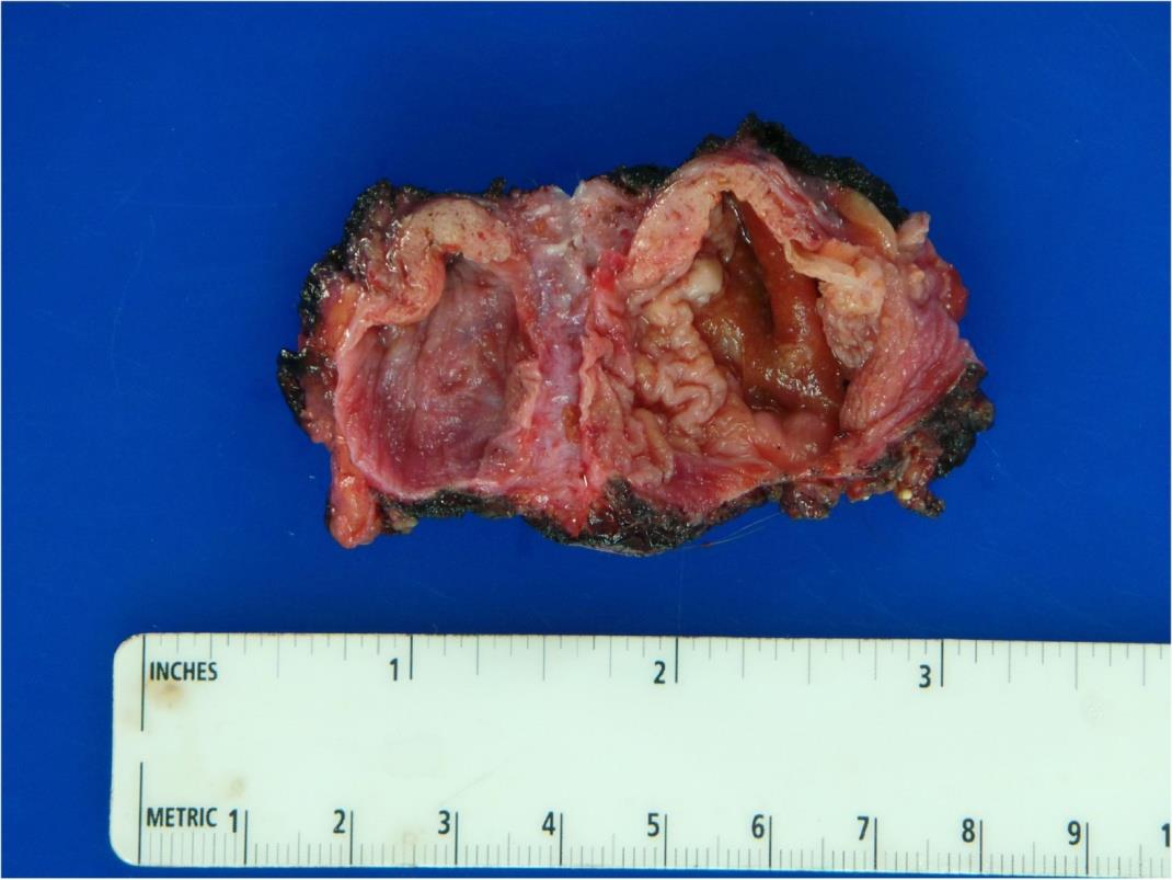 Figure 1: Gross Specimen. Bisected scrotal cyst showing a smooth, focally trabeculated, hemorrhagic cyst lining.