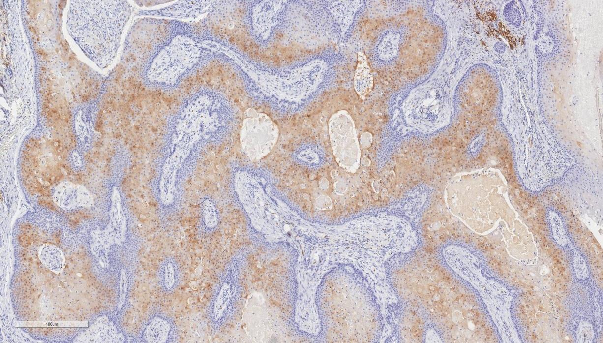 Figure 7: Calretinin, 200x. High power view of calretinin immunostain shows positivity in the tumor epithelium close to the lumen of the cystic structures in the PTT.